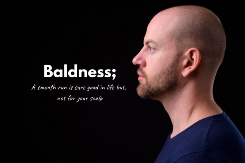 Cure Baldness With The Help Of Natural Remedies